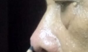 bisul di ujung hidung