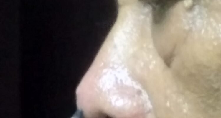 bisul di ujung hidung